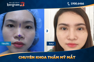 Hình ảnh cắt mí trước sau thẩm mỹ Kangnam - Ca 70