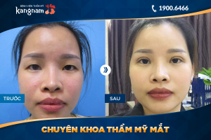 Hình ảnh cắt mí trước sau thẩm mỹ Kangnam - Ca 71