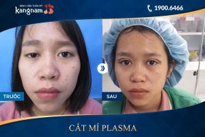 Hình ảnh cắt mí trước sau thẩm mỹ Kangnam - Ca 72