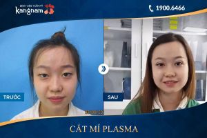 Hình ảnh cắt mí trước sau thẩm mỹ Kangnam - Ca 73