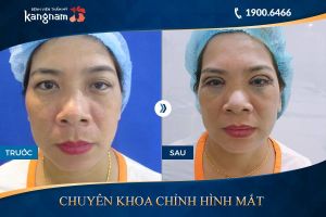 Hình ảnh cắt mí trước sau thẩm mỹ Kangnam - Ca 74
