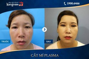 Hình ảnh cắt mí trước sau thẩm mỹ Kangnam - Ca 75