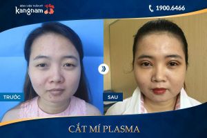 Hình ảnh cắt mí trước sau thẩm mỹ Kangnam - Ca 76