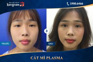 Hình ảnh cắt mí trước sau thẩm mỹ Kangnam - Ca 8