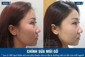 Hình ảnh nâng mũi trước sau bệnh viện thẩm mỹ JW Hàn Quốc - Ca 1