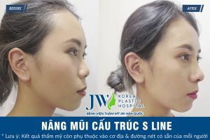 Hình ảnh nâng mũi trước sau bệnh viện thẩm mỹ JW Hàn Quốc - Ca 2