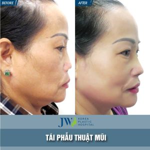 Hình ảnh nâng mũi trước sau bệnh viện thẩm mỹ JW Hàn Quốc - Ca 3