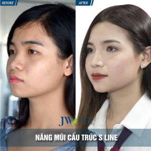 Hình ảnh nâng mũi trước sau bệnh viện thẩm mỹ JW Hàn Quốc - Ca 4