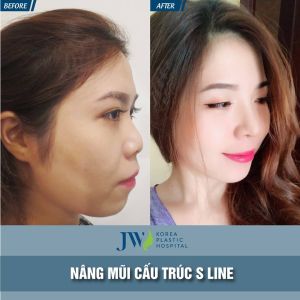 Hình ảnh nâng mũi trước sau bệnh viện thẩm mỹ JW Hàn Quốc - Ca 5