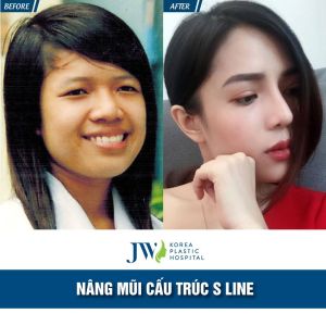 Hình ảnh nâng mũi trước sau bệnh viện thẩm mỹ JW Hàn Quốc - Ca 6