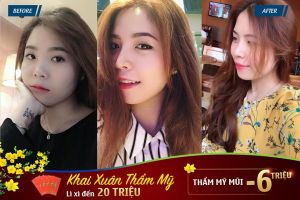 Hình ảnh nâng mũi trước sau bệnh viện thẩm mỹ JW Hàn Quốc - Ca 7