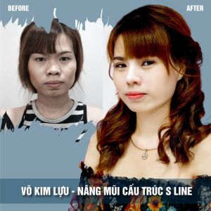 Hình ảnh nâng mũi trước sau bệnh viện thẩm mỹ JW Hàn Quốc - Ca 8