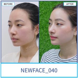 Hình ảnh nâng mũi trước sau Bs Trần Phương - Ca 40