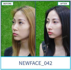 Hình ảnh nâng mũi trước sau Bs Trần Phương - Ca 42