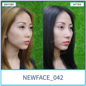 Hình ảnh nâng mũi trước sau Bs Trần Phương - Ca 42