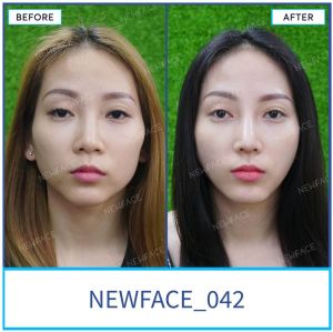 Hình ảnh nâng mũi trước sau Bs Trần Phương - Ca 42