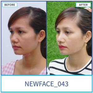 Hình ảnh nâng mũi trước sau Bs Trần Phương - Ca 43