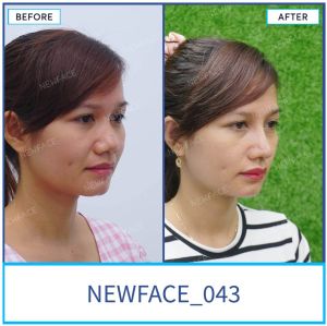 Hình ảnh nâng mũi trước sau Bs Trần Phương - Ca 43