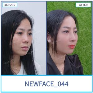 Hình ảnh nâng mũi trước sau Bs Trần Phương - Ca 44