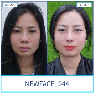 Hình ảnh nâng mũi trước sau Bs Trần Phương - Ca 44