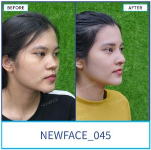 Hình ảnh nâng mũi trước sau Bs Trần Phương - Ca 45