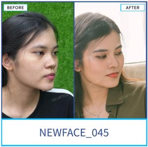 Hình ảnh nâng mũi trước sau Bs Trần Phương - Ca 45