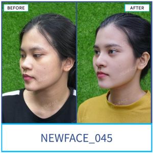 Hình ảnh nâng mũi trước sau Bs Trần Phương - Ca 45