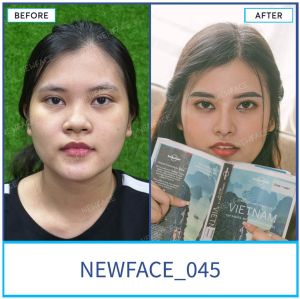 Hình ảnh nâng mũi trước sau Bs Trần Phương - Ca 45