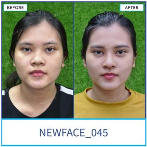 Hình ảnh nâng mũi trước sau Bs Trần Phương - Ca 45