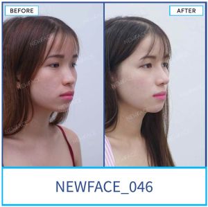 Hình ảnh nâng mũi trước sau Bs Trần Phương - Ca 46