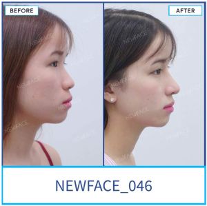 Hình ảnh nâng mũi trước sau Bs Trần Phương - Ca 46