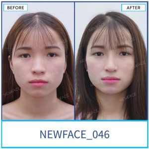 Hình ảnh nâng mũi trước sau Bs Trần Phương - Ca 46