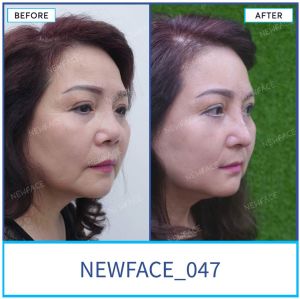 Hình ảnh nâng mũi trước sau Bs Trần Phương - Ca 47