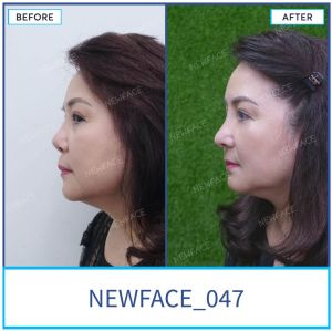 Hình ảnh nâng mũi trước sau Bs Trần Phương - Ca 47