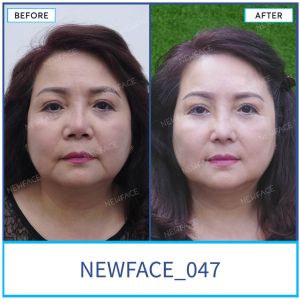 Hình ảnh nâng mũi trước sau Bs Trần Phương - Ca 47