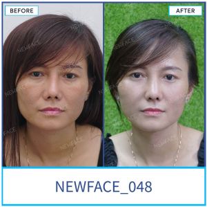 Hình ảnh nâng mũi trước sau Bs Trần Phương - Ca 48