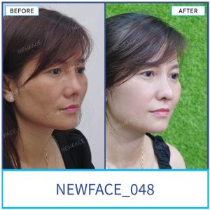 Hình ảnh nâng mũi trước sau Bs Trần Phương - Ca 48