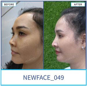 Hình ảnh nâng mũi trước sau Bs Trần Phương - Ca 49