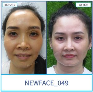 Hình ảnh nâng mũi trước sau Bs Trần Phương - Ca 49