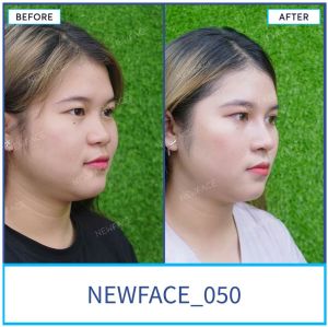 Hình ảnh nâng mũi trước sau Bs Trần Phương - Ca 50