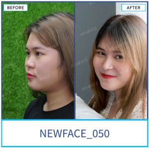 Hình ảnh nâng mũi trước sau Bs Trần Phương - Ca 50