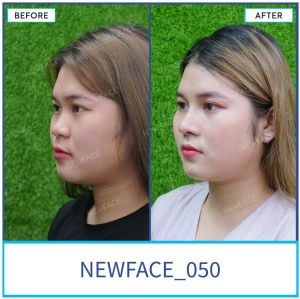 Hình ảnh nâng mũi trước sau Bs Trần Phương - Ca 50