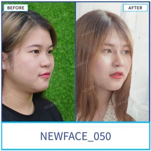 Hình ảnh nâng mũi trước sau Bs Trần Phương - Ca 50