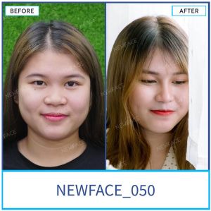 Hình ảnh nâng mũi trước sau Bs Trần Phương - Ca 50