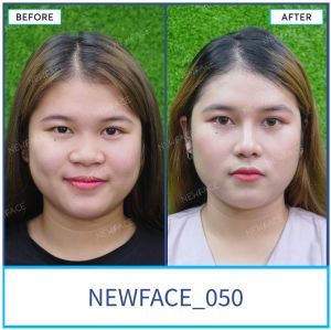 Hình ảnh nâng mũi trước sau Bs Trần Phương - Ca 50