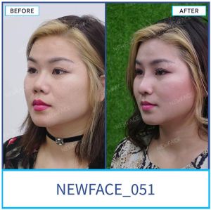 Hình ảnh nâng mũi trước sau Bs Trần Phương - Ca 51