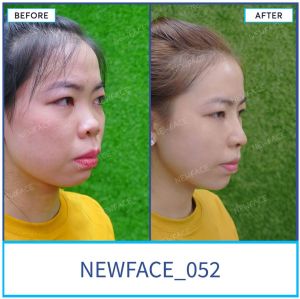 Hình ảnh nâng mũi trước sau Bs Trần Phương - Ca 52