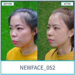 Hình ảnh nâng mũi trước sau Bs Trần Phương - Ca 52