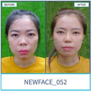 Hình ảnh nâng mũi trước sau Bs Trần Phương - Ca 52