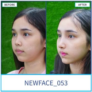 Hình ảnh nâng mũi trước sau Bs Trần Phương - Ca 53